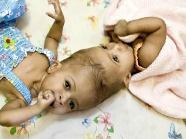 Сиамские близнецы были успешно разделены хирургами из Великобритании