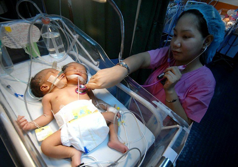 В Бразилии родился младенец с двумя головами