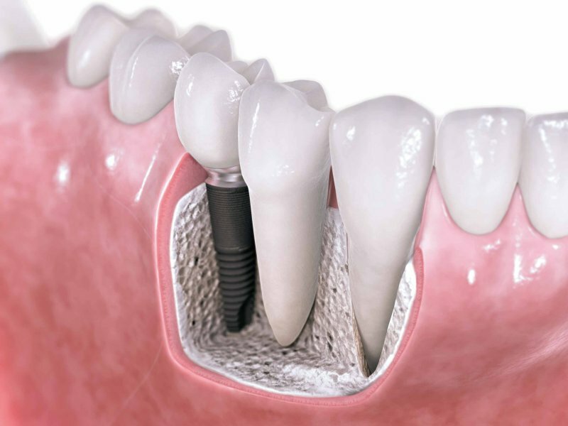 Что нужно знать пациенту перед проведением имплантации зубов?