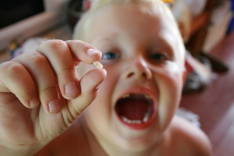 Удаление зубов детям
