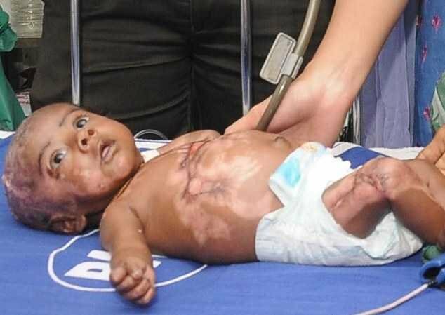 В больницу Индии доставили самовозгорающегося ребенка