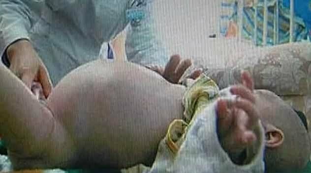 Двухлетний малыш из Китая оказался "беременным" своим братом-близнецом
