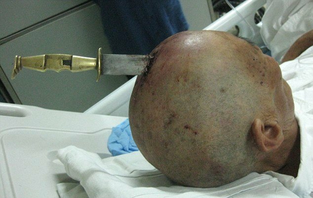 Заявившись в больницу с ножом в голове, пациент шокировал врачей