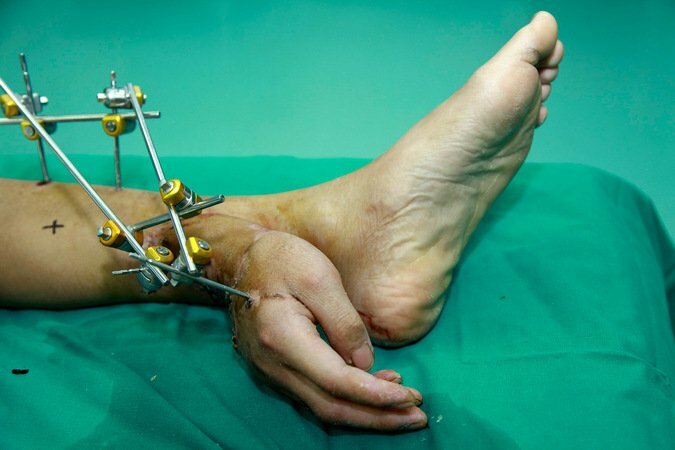 Китайские врачи на время пришили руку к ноге, а потом вернули ее на место