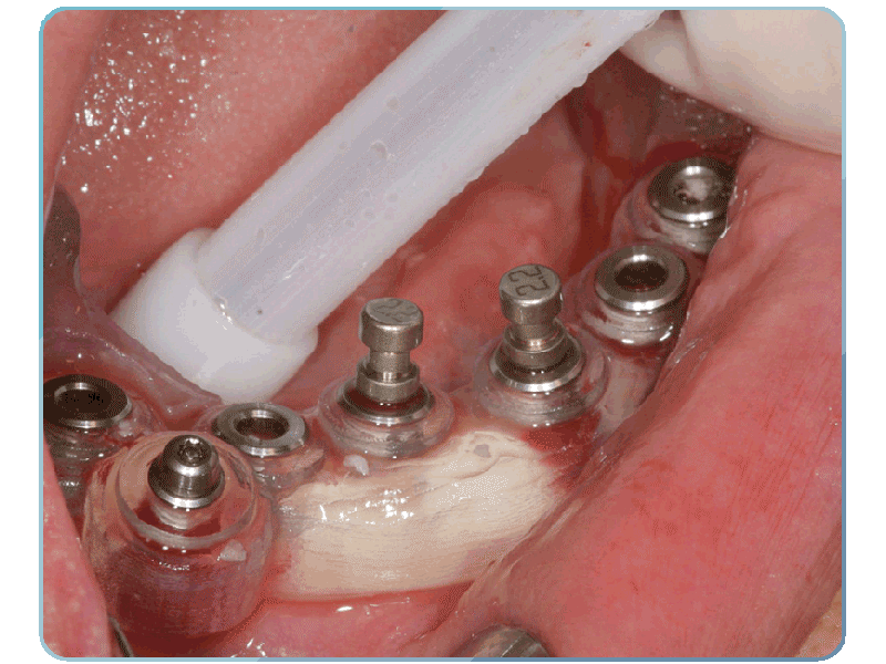 Современная стоматология: имплантация зубов