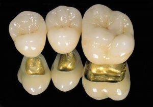 Эстетическое и качественное протезирование зубов – металлокерамика