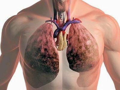 Революционный способ лечения рака лёгких