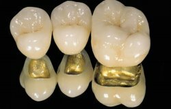 Эстетическое и качественное протезирование зубов – металлокерамика
